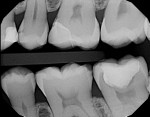 Postoperative bitewing radiograph taken to
ensure complete cleanup of resin cement.
