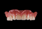Fig 10. Teeth are polymerized into the milled denture base, and the denture is finalized by either polishing or staining and glazing the gingiva base for a more characterized appearance.