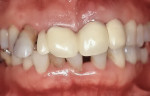 Fig 6. Clinical photograph of patient in Case 2 at initial visit. Patient complained of chewing impairment due to tooth mobility.