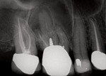 Radiograph of tooth No. 3, revealing periapical pathology.