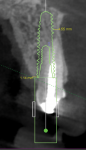 Fig 3. A DICOM image of an implant relative to tooth No. 9. Implants should be placed more apical and palatal than the natural tooth apex, especially in the esthetic zone.