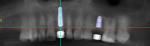 Fig 6. The reconstructed panoramic CBCT scan from the DICOM files.