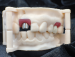 Fig 12. The custom abutments are evaluated on a 3D-printed analog model.