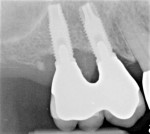 Fig 4. Radiographic bone level was at third thread 12 years post placement of restoration.