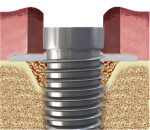Fig 2. Bone graft material is placed within the infrabony defect and a collagen membrane
covers the graft.