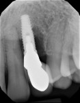 Fig 22. Advanced bone loss was visible radiographically.