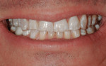 Facial view of patient’s smile showing severe wear.