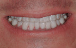 Patient’s smile with final mandibular restorations
in place.
