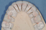 Occlusal view of final maxillary pressable ceramic restorations.