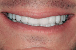 Unretracted facial view demonstrating improved coloration and condition of the worn dentition.