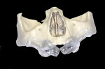 Fig 5. Anatomical prototyping model and surgical guide for zygomatic implants.