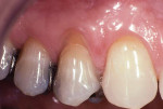 Preoperative image of a facial gingival recession defect associated with tooth No. 5.