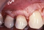 Gingival flap completely secured over ADM and root surface using a continuous suture.