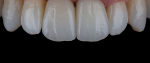 Fig 7. Multilayer zirconia can offer exceptional monolithic esthetics and predictable processing from diagnostic to final.
