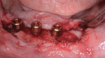 Fig 6. Placement of the legacy LOCATOR abutments and bone graft in crater defect prior to suturing.