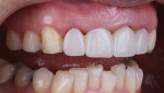 Fig 9. The Trial Smile (DenMat), made from a previous wax-up and which is included with the A.R.T. technique, was tried in. Temporaries (Perfectemp® 10, DenMat) will remain until the implant is ready to be restored.