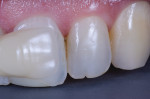 Initial preferred shade demonstrated by tooth No. 10 with custom A3 tab.