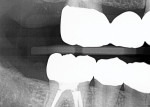 Postoperative radiographs showing the marginal integrity and accurate fit of the posterior zirconia restorations.