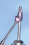 Fig 7. A 30-degree SRA was chosen for the implant on tooth No. 14.