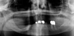 Fig 12. Initial radiographic assessment showing significant right posterior saddle deformity and thin mandibular alveolus in the symphysis area.