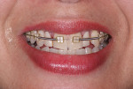 Fig 7. Orthodontic treatment following implant placement.