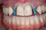 Fig 13. Coping transfer abutments. Gingivectomy was performed with a dental laser.