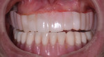 Fig 6. Patient presented with ill-fitting acrylic “snap-on” maxillary provisional and full mandibular denture.