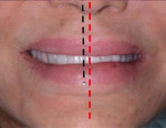 Fig 8. The patient’s facial midline, demarcated by the red dotted line, did not coincide with the dental midline, indicated by the black dotted line.