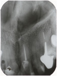 Fig 1. Pretreatment radiograph of tooth No. 9 showed satisfactory endodontic treatment and absence of periapical bone rarefaction.