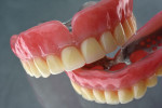 Fig 5. For this denture made with both milled dentures and milled teeth, Avadent materials and Avadent design were customized with composite and added metal frames.