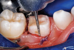 Axial preparation completed after occlusal reduction.