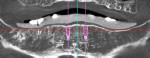 Fig 6. Cross-sectional views of CBCT with parallel implants simulated at the canine poitions.