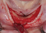 Fig 12. Full-thickness flap was reflected with a vertical incision along the midline to allow for exposure of and access to the ridge crest.