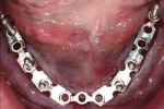 Fig 17. The guide was bent to conform the the dental arch and secured in position on edentulous mandibular ridge. Segments were added to allow for placement of six implants, at the canine, first premolar, and first molar positions.