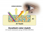 Fig 6. OMNICHROMA provides an excellent color match with either an A1 shaded tooth (Fig 6) or an A4 shaded tooth (Fig 7).