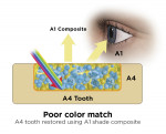 Fig 5. An A1 shaded tooth restored with A1 shade composite offers an excellent color match (Fig 4). An A4 shaded tooth restored with A1 shade composite provides a poor color match (Fig 5).