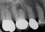 Preoperative radiograph of periapical lesion associated with teeth Nos. 2 and 3.