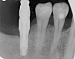 Fig 6. A 4.1-mm diameter implant placed in edentulous first molar site (No. 30) adjacent to a nonrestored bicuspid (No. 29) with no previous caries, seen at the time of final prosthesis impression visit.