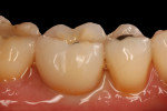 Fig 9. Placement of an 8-mm diameter implant with a 6.5-mm platform immediately upon extraction of tooth No. 30 (Fig 8) resulted in excellent crown contours, minimal gingival embrasure space, and reduced ITD (Fig 9).