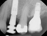 Fig 7. Periapical radiograph showing complete seating of the impression coping with the aid of the novel verification guide, indicated by the platform of the guide being flush with the platform of the coping.