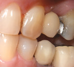 Fig 9. Final crown delivered, buccal view.