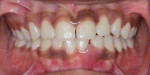 Pretreatment retracted full-mouth photograph showing localized swelling and lack of pigmentation in the area of teeth Nos. 23 and 24 with a diastema between them.
