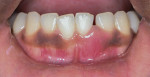 Pretreatment close-up view of lower anterior teeth showing open contact, incisal chip, swelling, and lack of pigmentation.