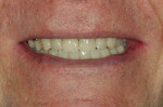 Fig 15. Final full smile; note the closure of the diastema between teeth Nos. 8 and 9, which was achieved by addressing occlusion.