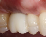 Fig 15. Three years after placement, the final restoration remained esthetic and functional.