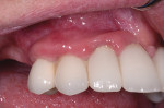 Fig 1. Pretreatment view of dental implants at right premolar, canine, and lateral incisor sites. Probings ranged up to 9 mm with heavy bleeding and purulence.
