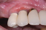 Fig 7. At 6 months there was some gingival recession, but inflammation was still present beyond what was anticipated.
