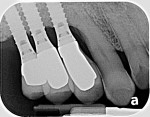 Fig 18. Radiograph at 3 years suggested that the hard-tissue levels on the dental implants remained stable. Exposed implant threads appear to have been reduced or eliminated.