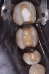 Final preparations for teeth Nos. 29 (distal-occlusal), 30 (mesial-occlusal-distal), and 31
(mesial-occlusal).