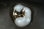 Finished gold inlay seated on an extracted
tooth with zinc phosphate cement.